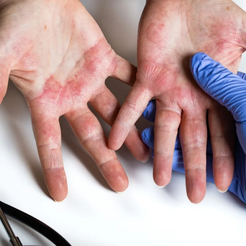 Tratamento de dermatite atópica